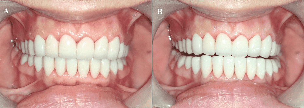 Full Mouth Rehabilitation in ahmedabad