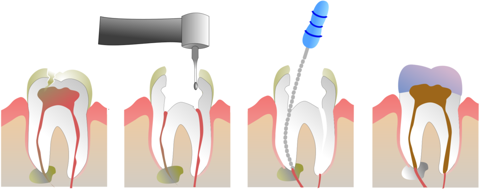 Surgical Extraction in ahmedabad 